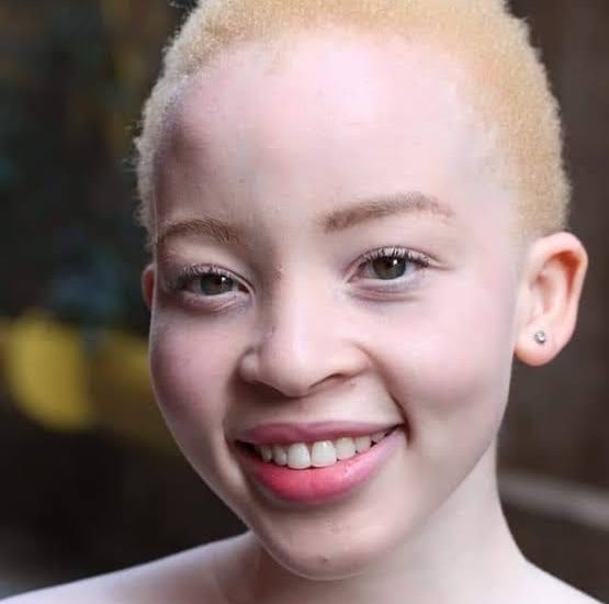 International Albinism Day 2020